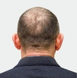 Hair transplant 1